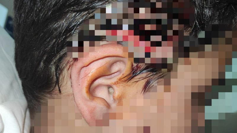 Bursa'da 8 köpeğin saldırısına uğrayan çocuğa 80 dikiş atıldı