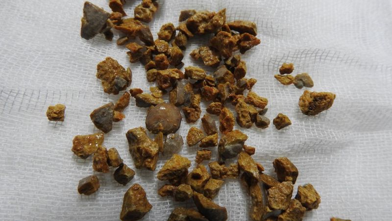 Çanakkale’de kadının böbreğindeki taş, 100 parçaya ayrılarak çıkarıldı