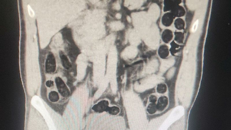 Batman'da İranlı yolcunun midesinden eroin çıktı