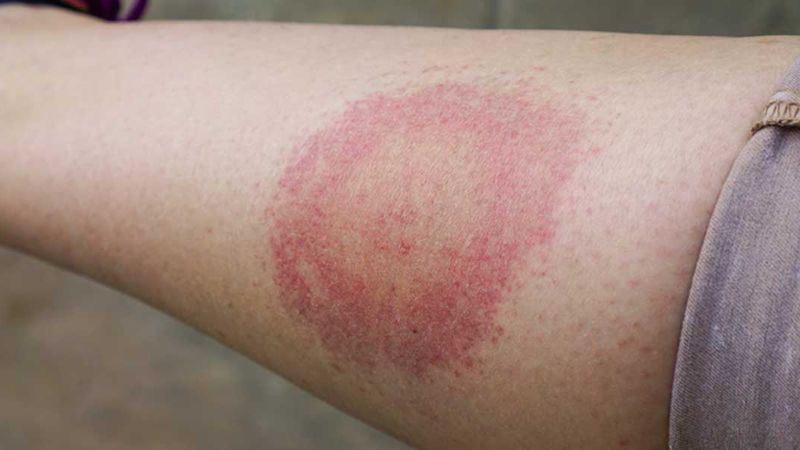 Lyme hastalığı nedir? Lyme hastalığının belirtileri nelerdir ve nasıl tedavi edilir?