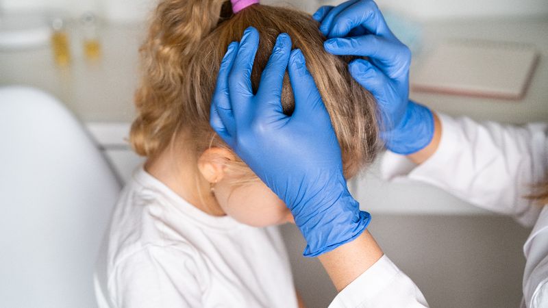 Saçta bit oluşumu, belirtileri ve tedavi yöntemleri