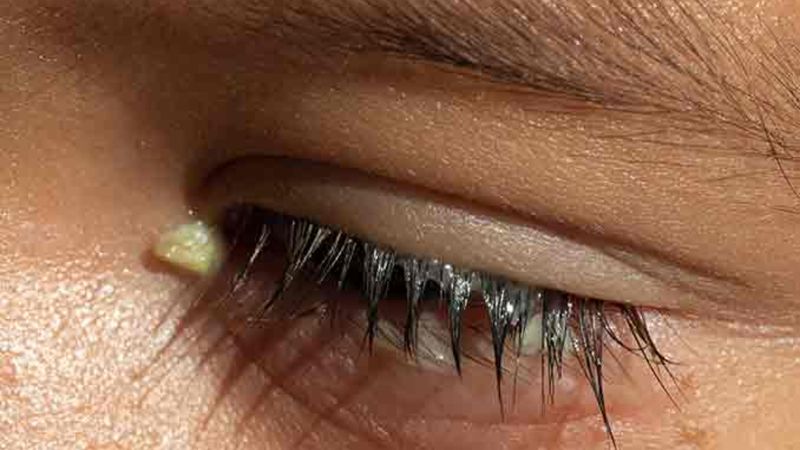 Çapaklı uyananlar dikkat! Bakın asıl sebebi neymiş...