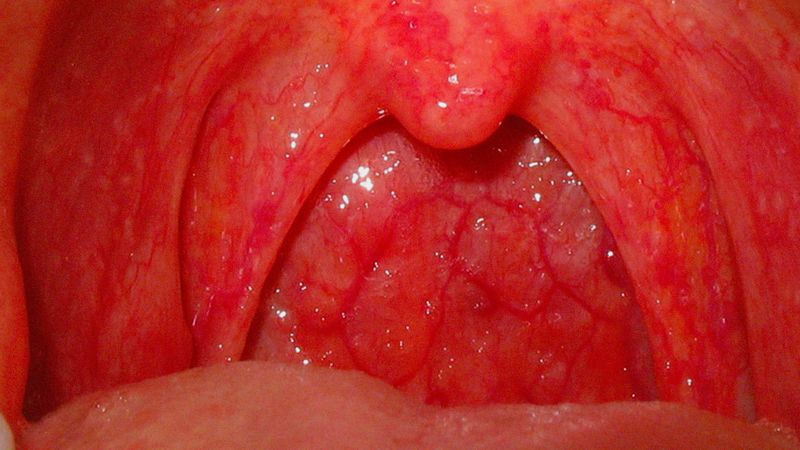 HIV'den kansere kadar birçok hastalığın habercisi! Boğaz yanmasını hafife almayın