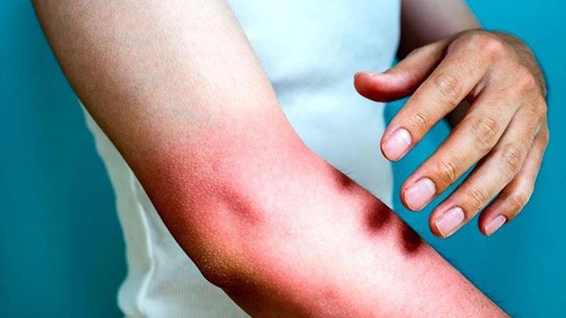 İlk ve Acil Yardımı Uzmanı uyardı: Yanıklara sakın bunlarla müdahale etmeyin!