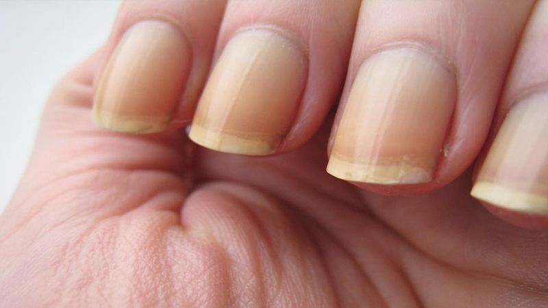 Aman es geçmeyin! Sararan tırnaklar, meğer o hastalığın habercisiymiş…