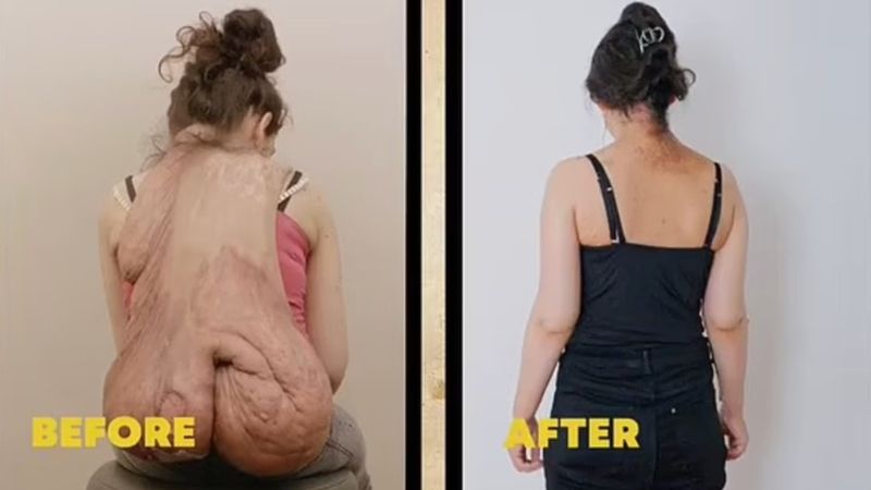 Almanya'da 20 kiloluk tümörle yıllarca yaşadı! Ameliyat hayatını değiştirdi