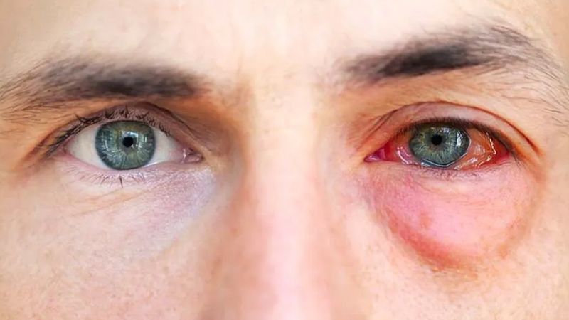 Baharın habercisi: Göz alerjisi belirtileri neler? Nasıl tedavi edilir?