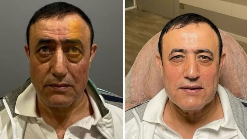Mahmut Tuncer estetik yaptırdı