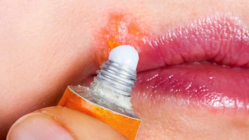 Dudağınızın dostu, uçukların düşmanı! İşte en iyi 5 uçuk kremi