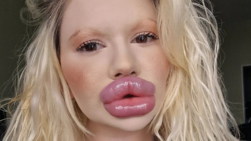 32 estetik geçirdi: Dünyanın en büyük dudaklarına sahip...