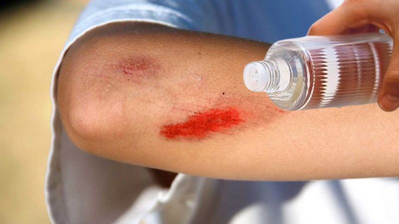 Herkes mikroplar öldüğü için sanıyordu! Meğer yaralara kolonya döküldüğünde yanmasının sebebi…