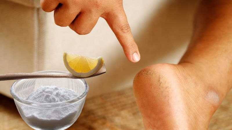 Evde kolay çözüm: Limon suyu ile karıştırıp sürün, ayak nasırına 1 günde veda edin