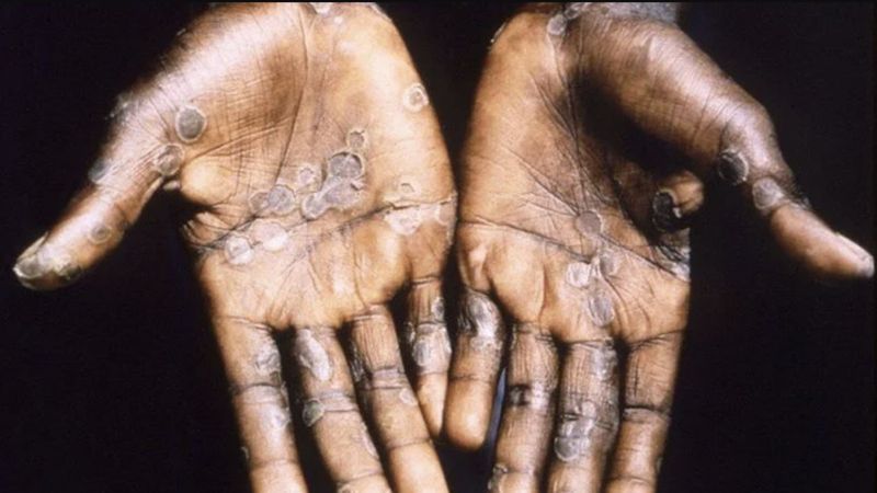 Maymun çiçeği Afrika'da kontrolden çıktı