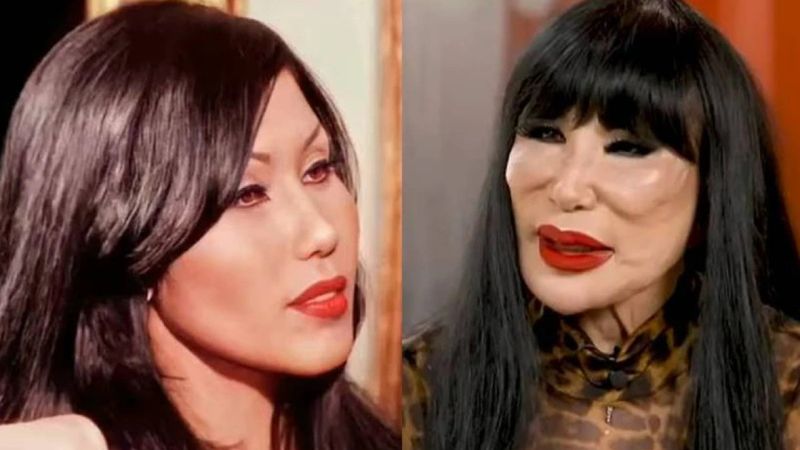 Meksika'da estetik skandalı: Yüzüne yemeklik yağ enjekte edildi