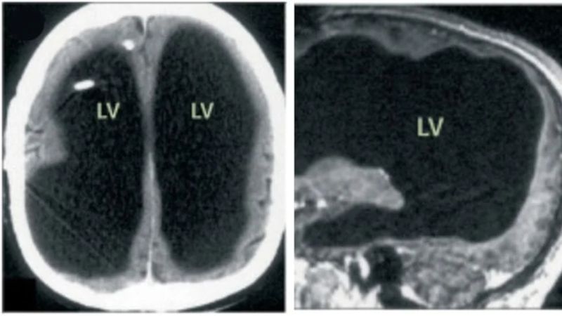 Fransa'da bacak ağrısı yüzünden hastaneye gitti: Yıllarca yarım beyinle yaşadığını öğrendi