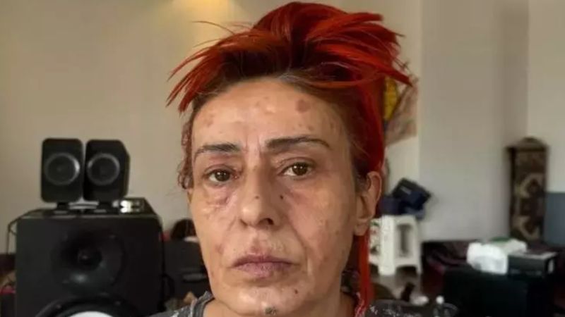 Saç boyası yüzünden yüzünde yanıklar oluşmuştu! Yıldız Tilbe son durumunu açıkladı
