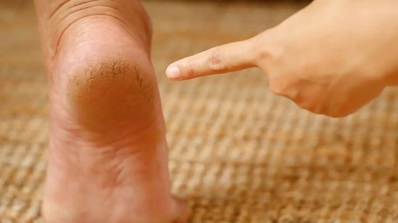 Ayaklarınızda 1 gece bekletin, sandalet ve terlikleri rahatça giyin...