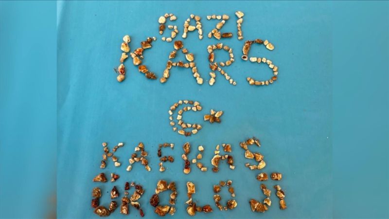 Kars'ta hastanın iki böbreğinden 300'ün üzerinde taş çıktı