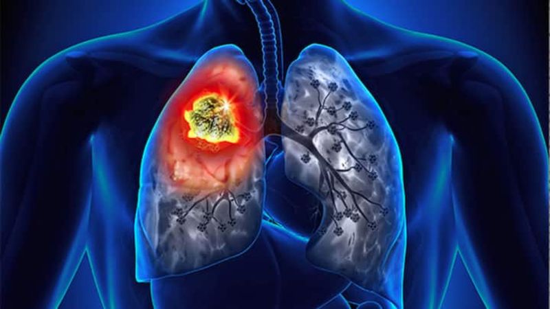 Hava kirliliği sigara içmeyenlerde akciğer kanserine yol açıyor