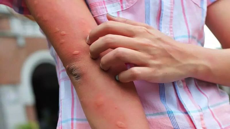 Ne sivrisinek, ne arı! Bu yazın en tehlikeli ısırığı: Kendini böyle belli ediyor