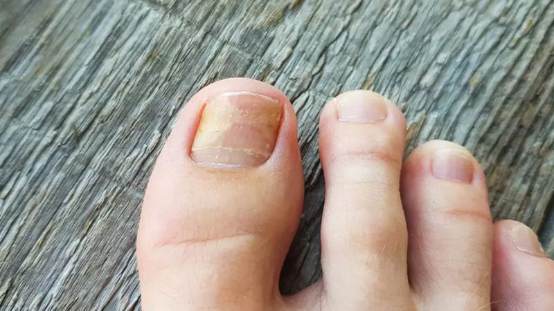 Tırnak mantarına doğal çözüm: 2 malzeme yetiyor, mantardan eser kalmıyor
