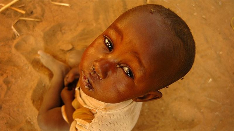 UNICEF'ten Sudan uyarısı: 5 yaş altı 640 bini aşkın çocuk, açlık ve hastalık yüzünden risk altında