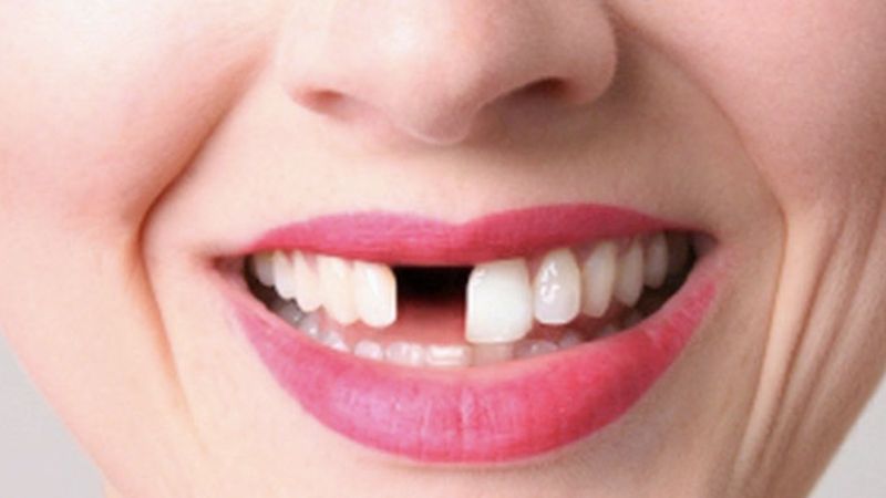 Diş eksikliği, yüz estetiğinde bozulmaya neden oluyor