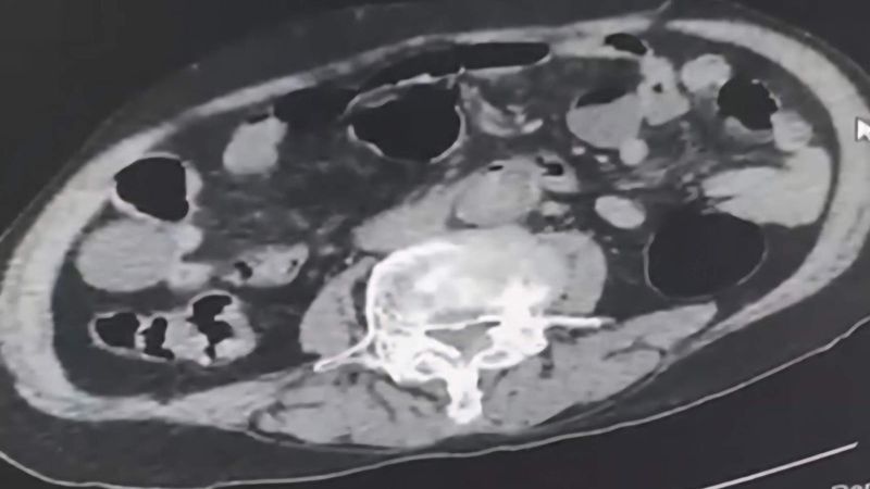 Denizli'de uyuşturucu operasyonu: Cinsel organında bulundu