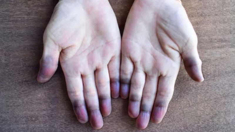 Sigara içenler dikkat: Bu hastalık sinsi ilerliyor, doku kaybına neden oluyor