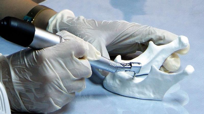 SGK implant tedavisini karşılıyor mu? Ücretsiz implant şartları 2025