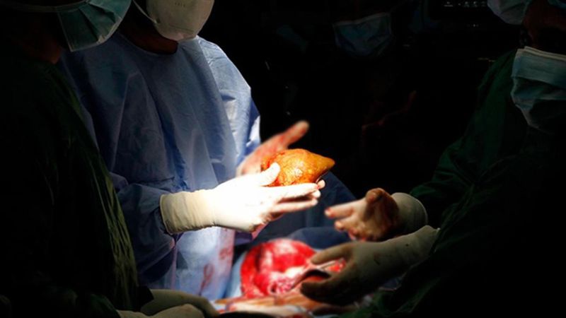 ABD'de kuduzlu böbrek nakli yapıldı: Hayatını kaybetti