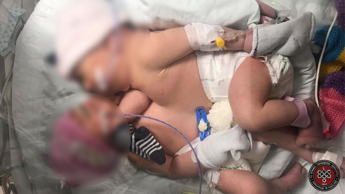 Siamese twins separated 8 days after birth #3