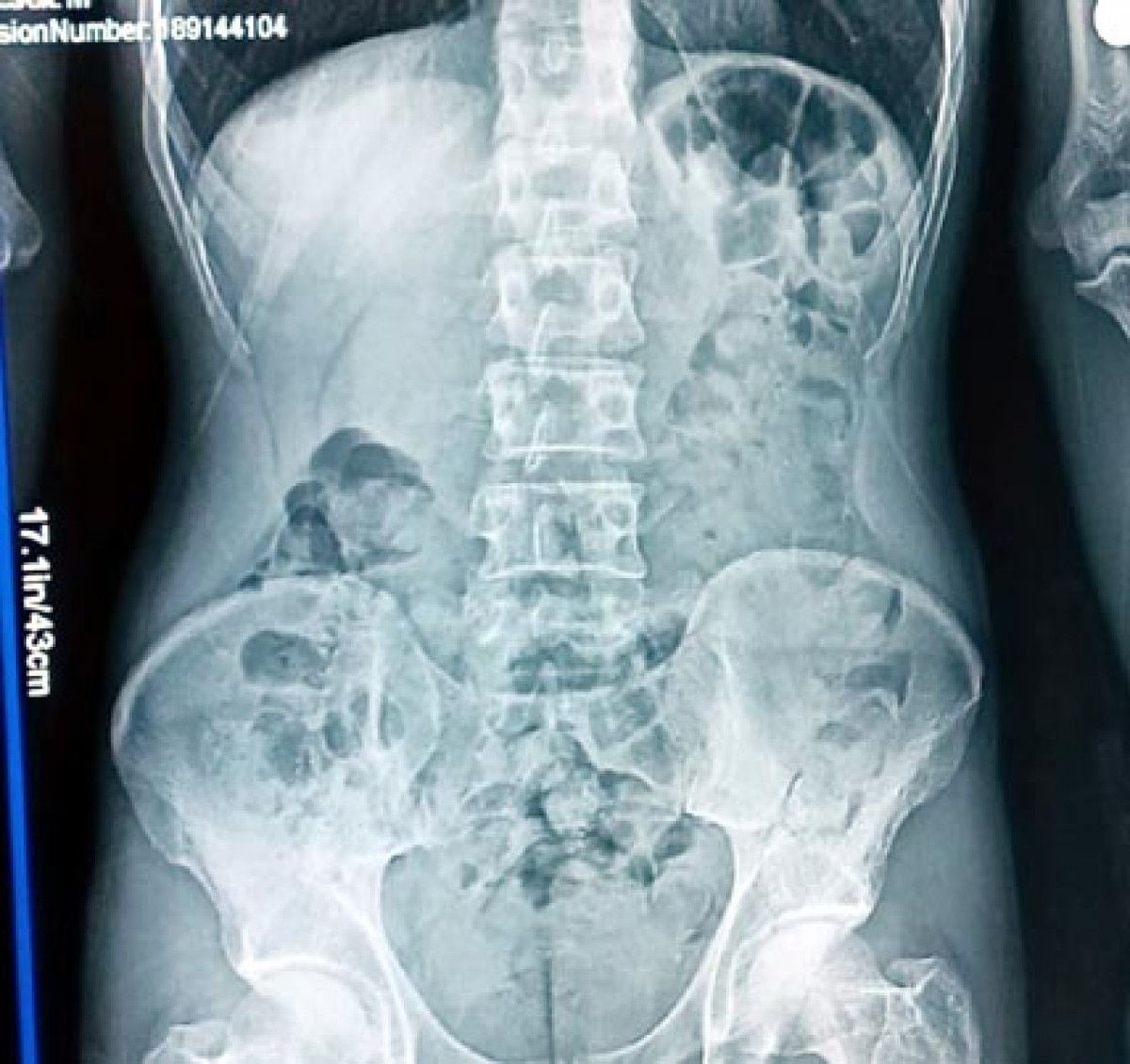 Bolu da  şahsın midesinden kapsül halinde uyuşturucu çıktı #5