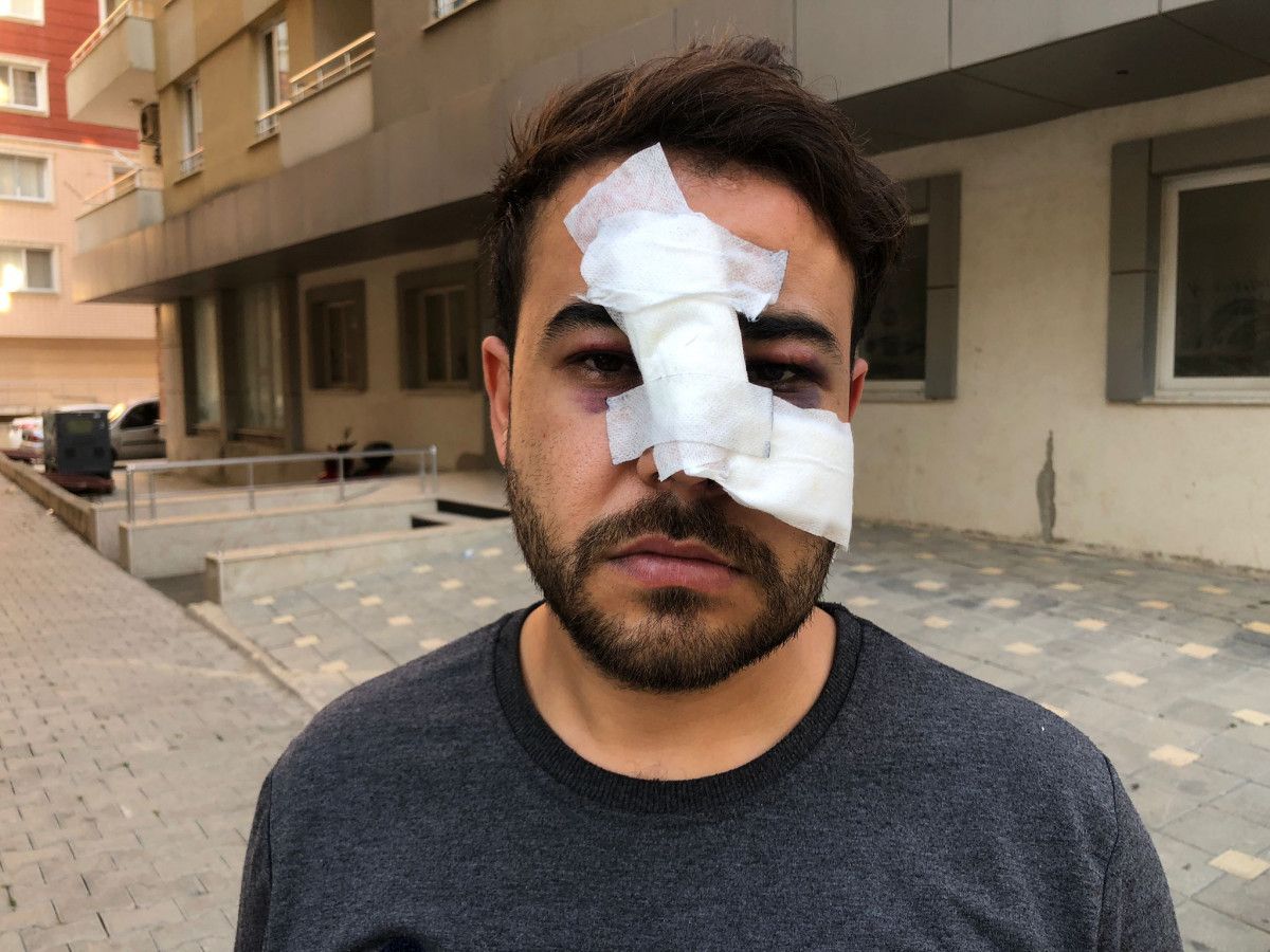 Hatay da sokak sanatçısının yüzünde şişe kırıp,  Biz sana mı vurduk  diye sordular #1