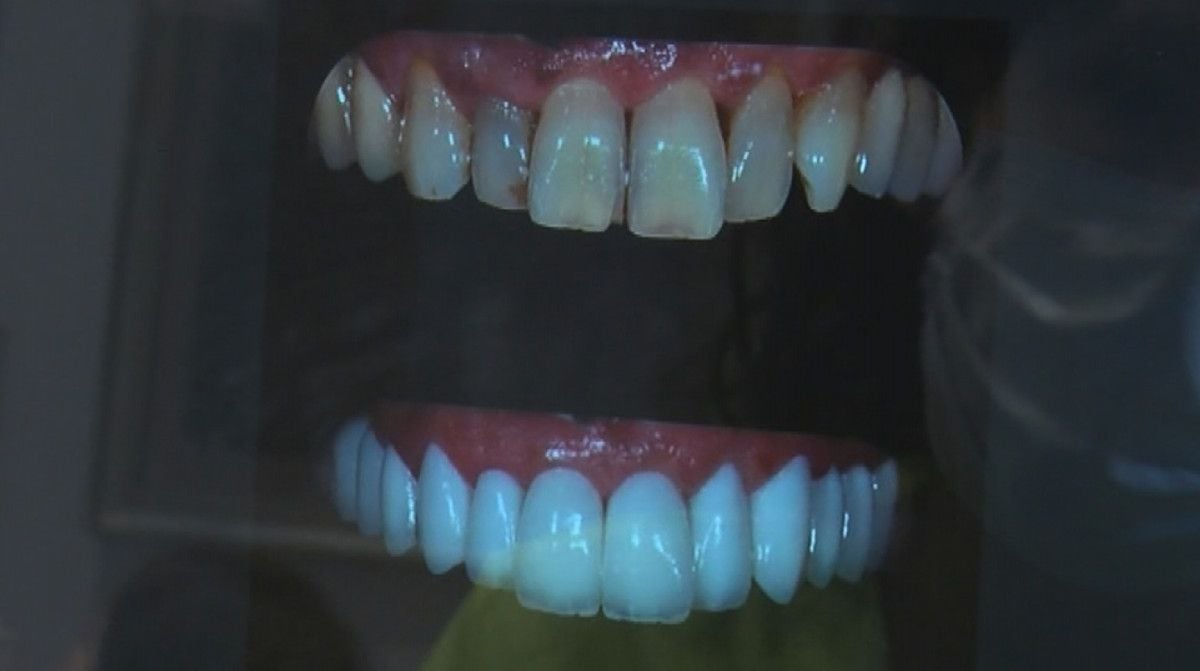 Porselen diş çılgınlığı: Sanıldığı kadar masum değil #5