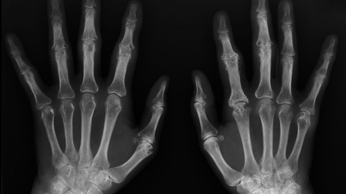 What is bone age, how is it calculated?  Which department looks at the bone age measurement?