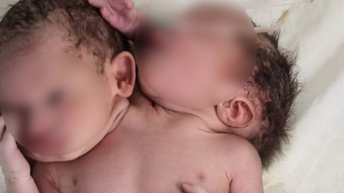 Double-headed baby born in India