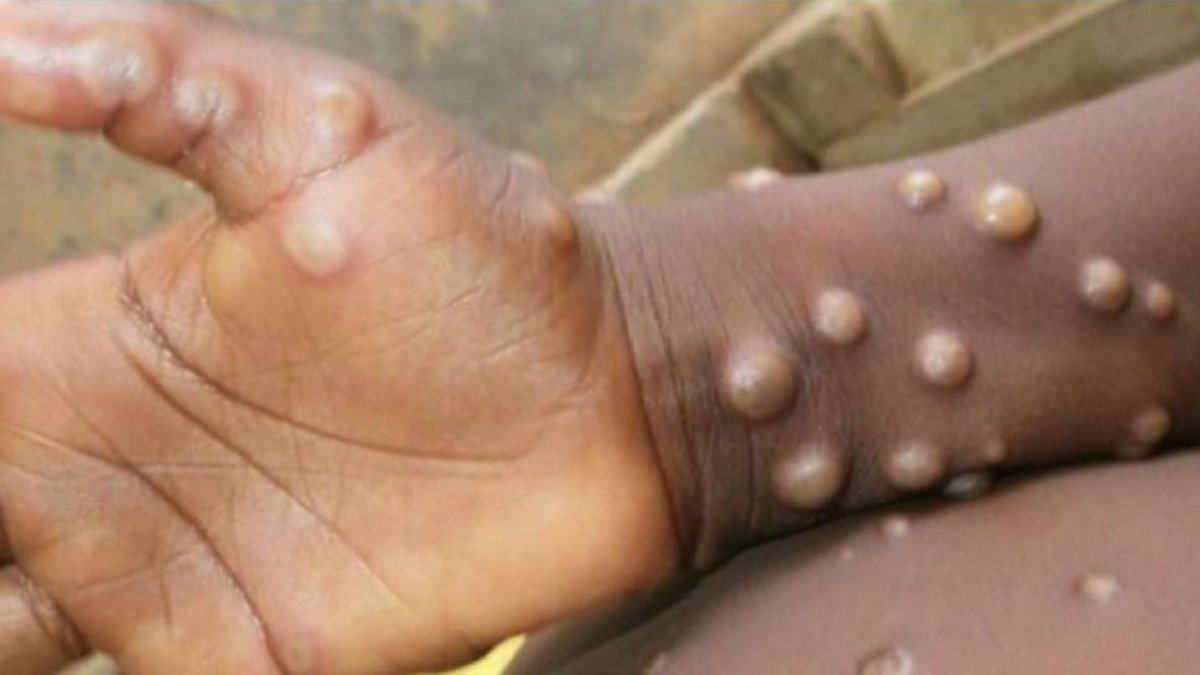 African press members reacted due to monkeypox virus