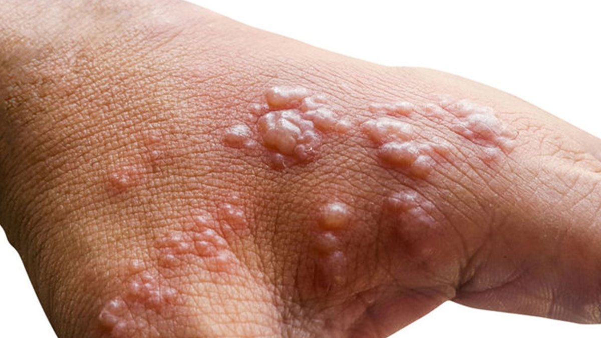 First Monkeypox case seen in Japan