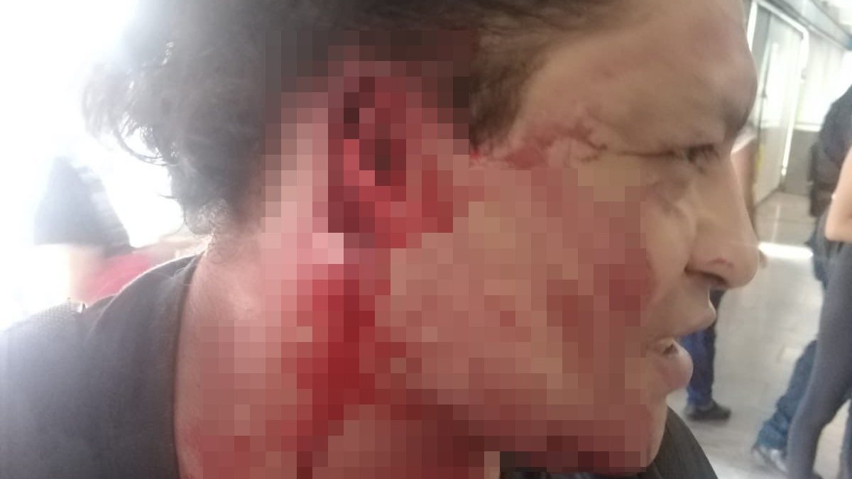 Meksika'da taciz ettiği iddia edilen kişinin kulağını koparttı