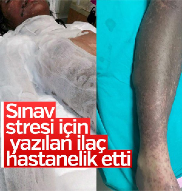 Deri hastalığına yakalanan öğrenci yoğun bakımda