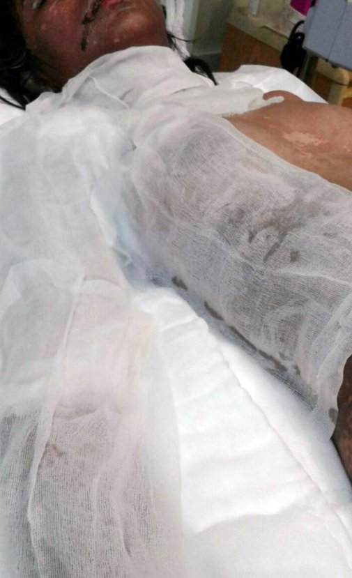 Deri hastalığına yakalanan öğrenci yoğun bakımda