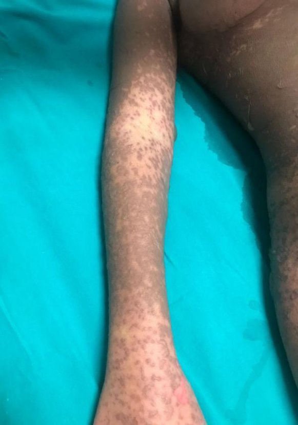 Deri hastalığına yakalanan öğrenci yoğun bakımda