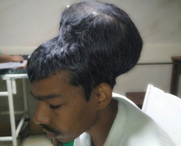 Hindistan'da doktorlar en büyük beyin tümörünü çıkardı