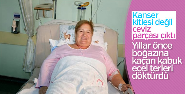 65 yaşındaki kadının akciğerinden ceviz parçası çıktı