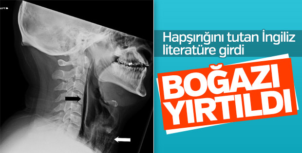 Hapşırırken boğazı yırtıldı