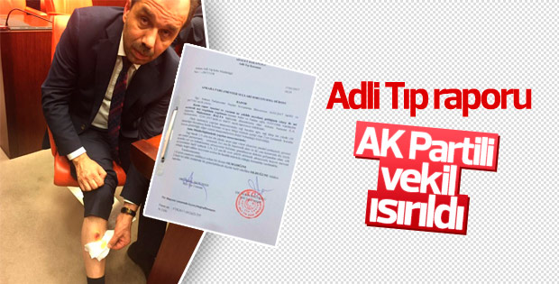 AK Partili vekil ısırıldığına dair Adli Tıp raporu aldı