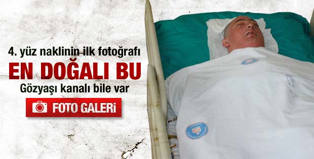 4. yüz naklinden ilk fotoğraf