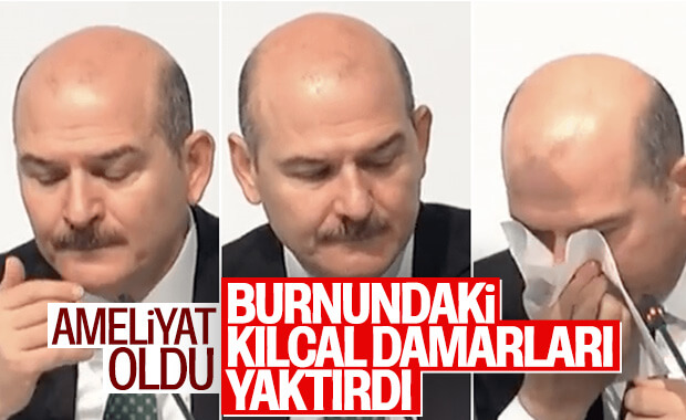 Süleyman Soylu'nun burnundaki kılcal damarları yakıldı