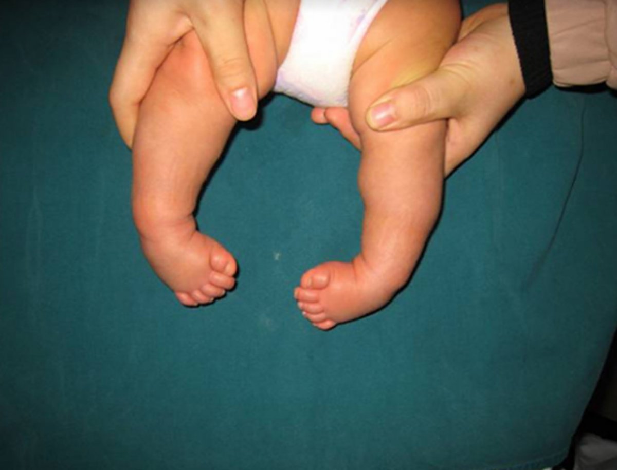Çarpık ayak nedir